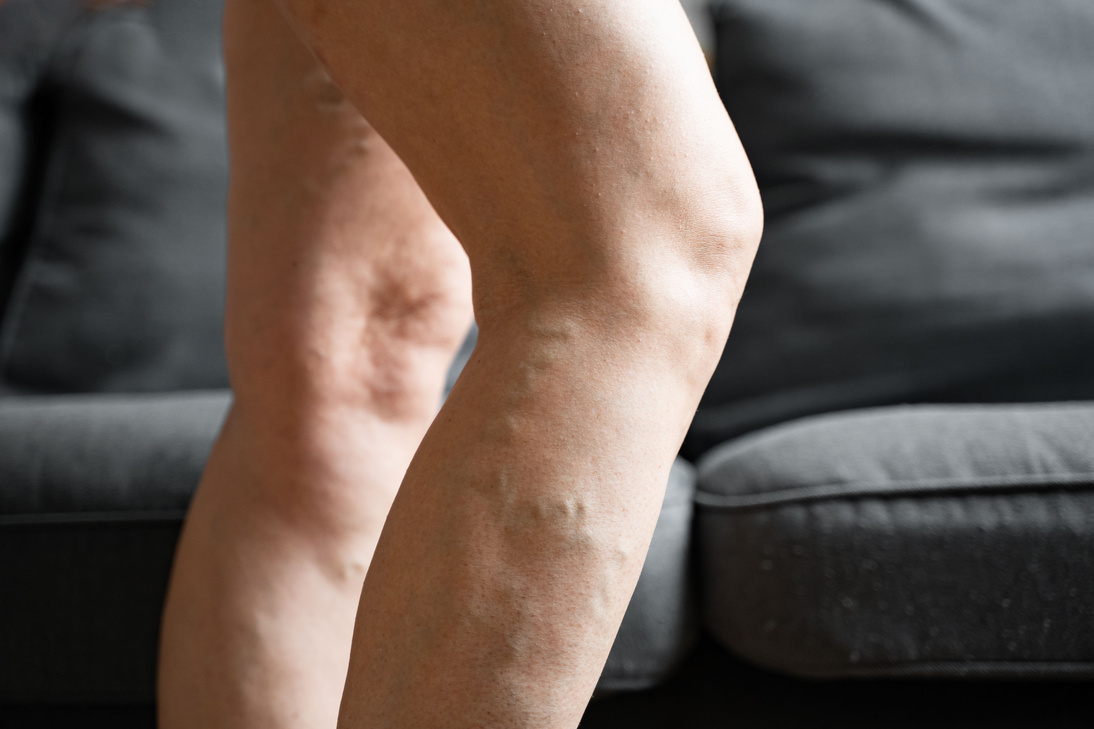 Varicose Vein Close up Leg