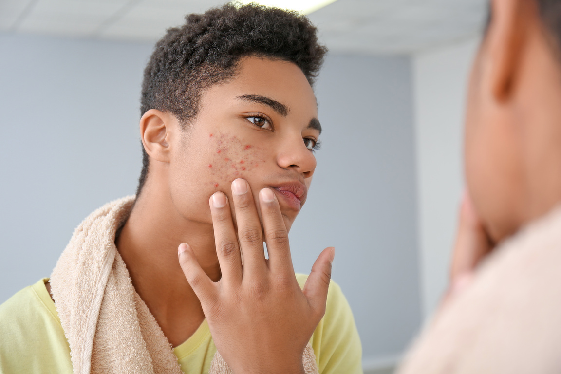 African-American Teenage Boy with Acne Problem at Home